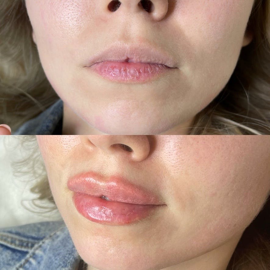 Контурна пластика губ