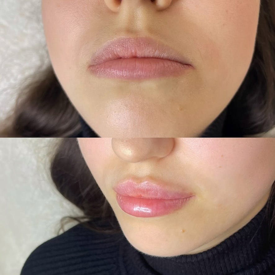 Контурна пластика губ