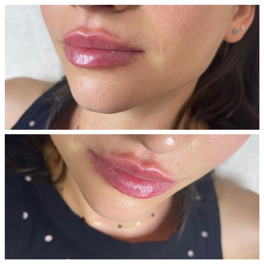 Контурна пластика губ