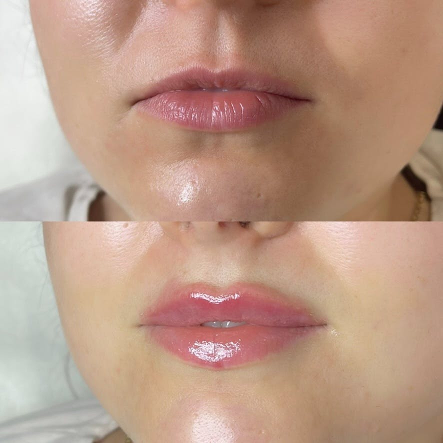 Контурна пластика губ