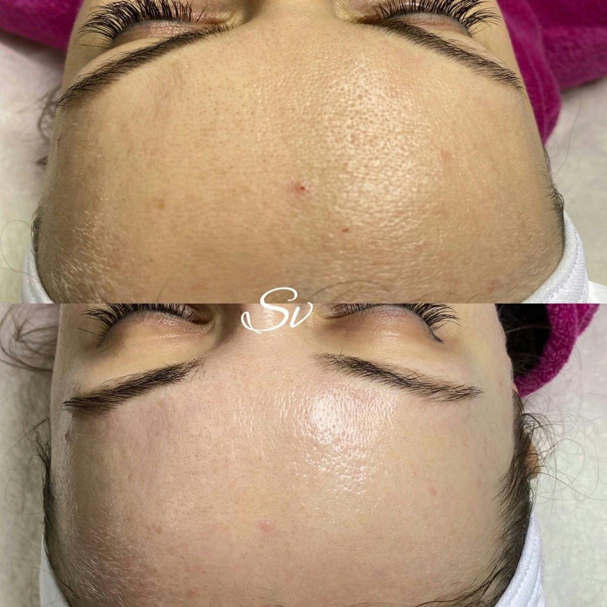 Карбоксітерапія