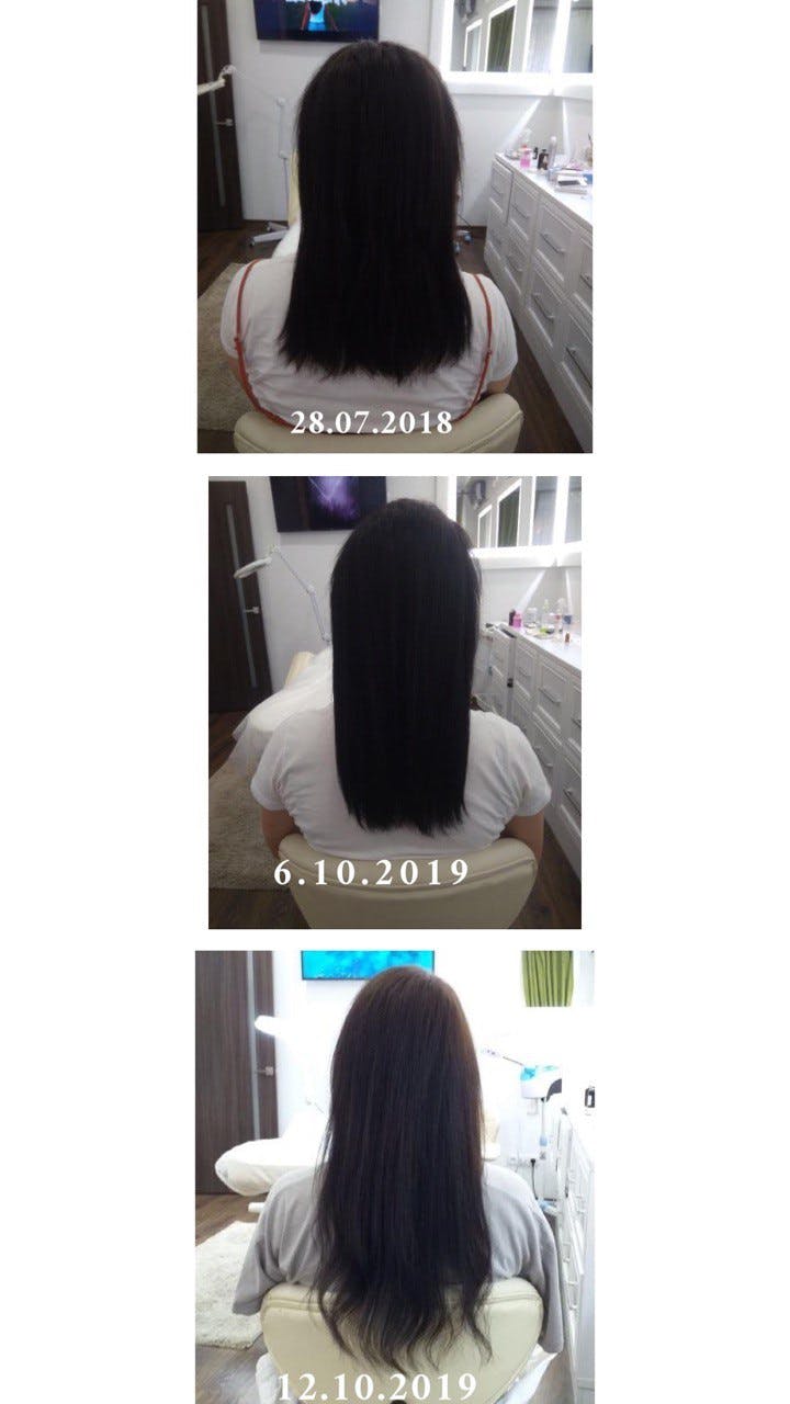 Мезотерапія волосяної частини голови