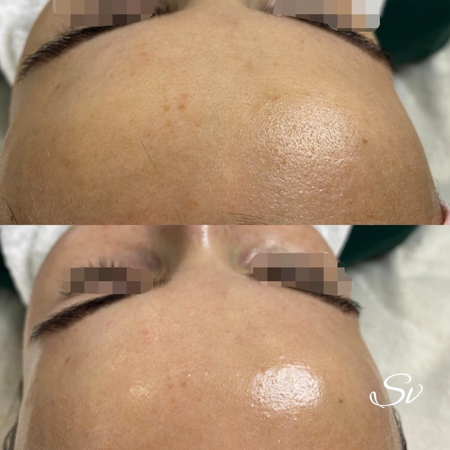 Процедура "Вогонь та лід"