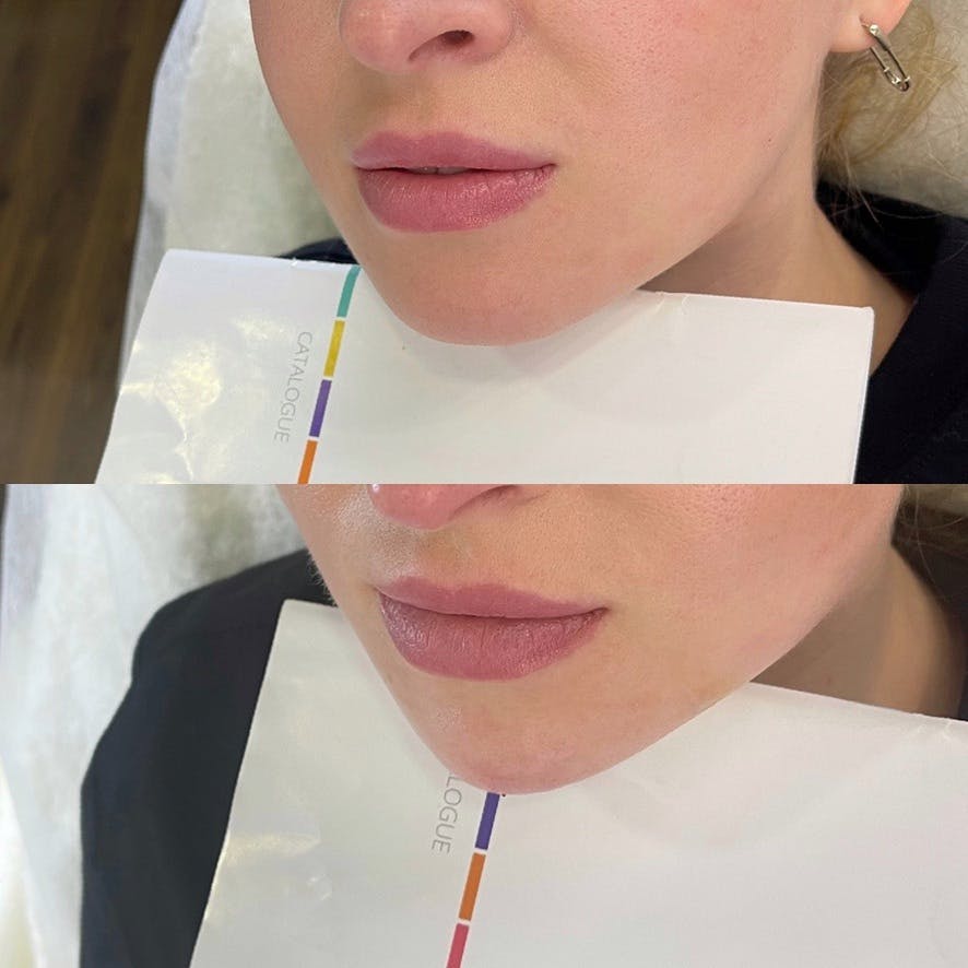 Контурна пластика підборіддя/кути нижньої щелепи