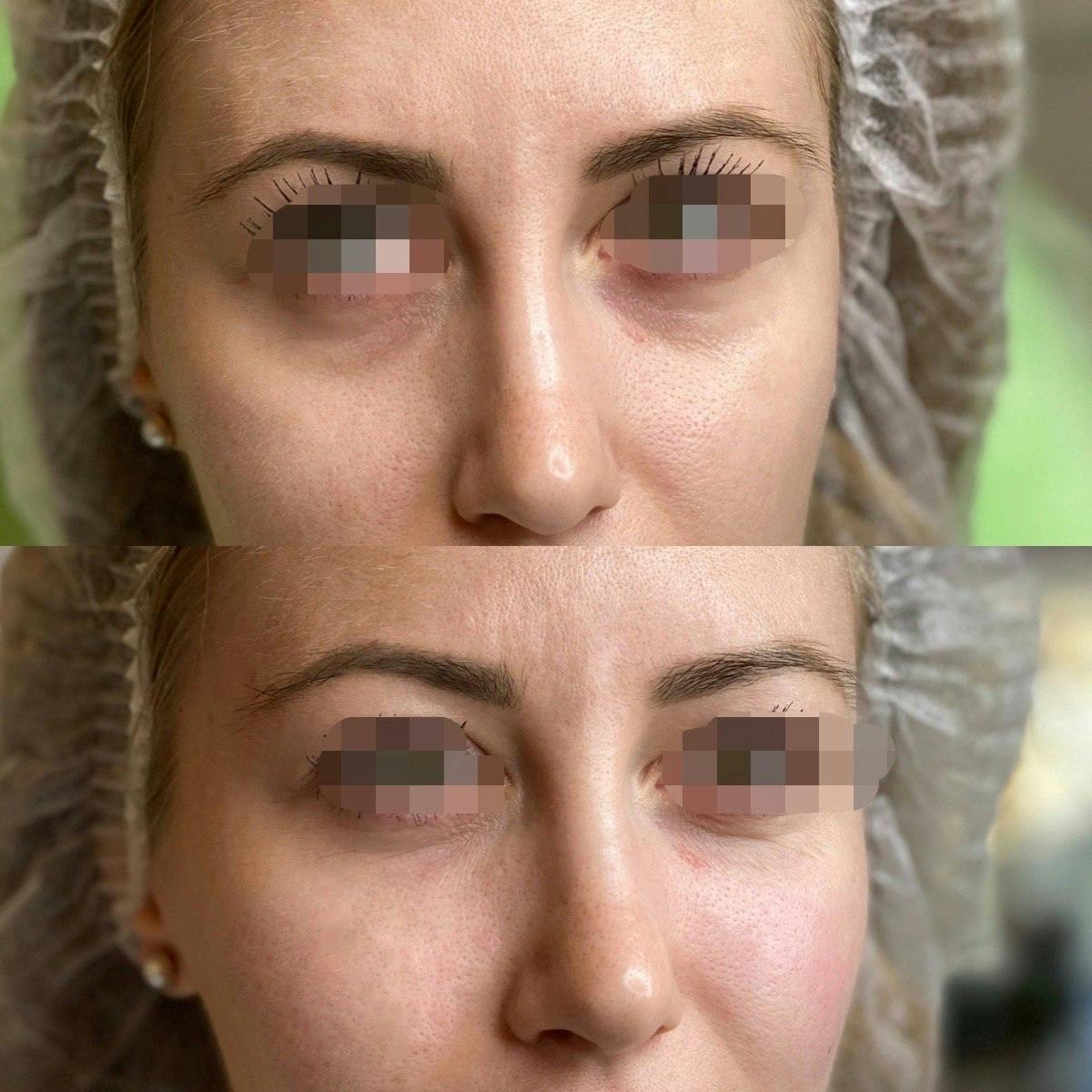 Корекція носослізної борозди