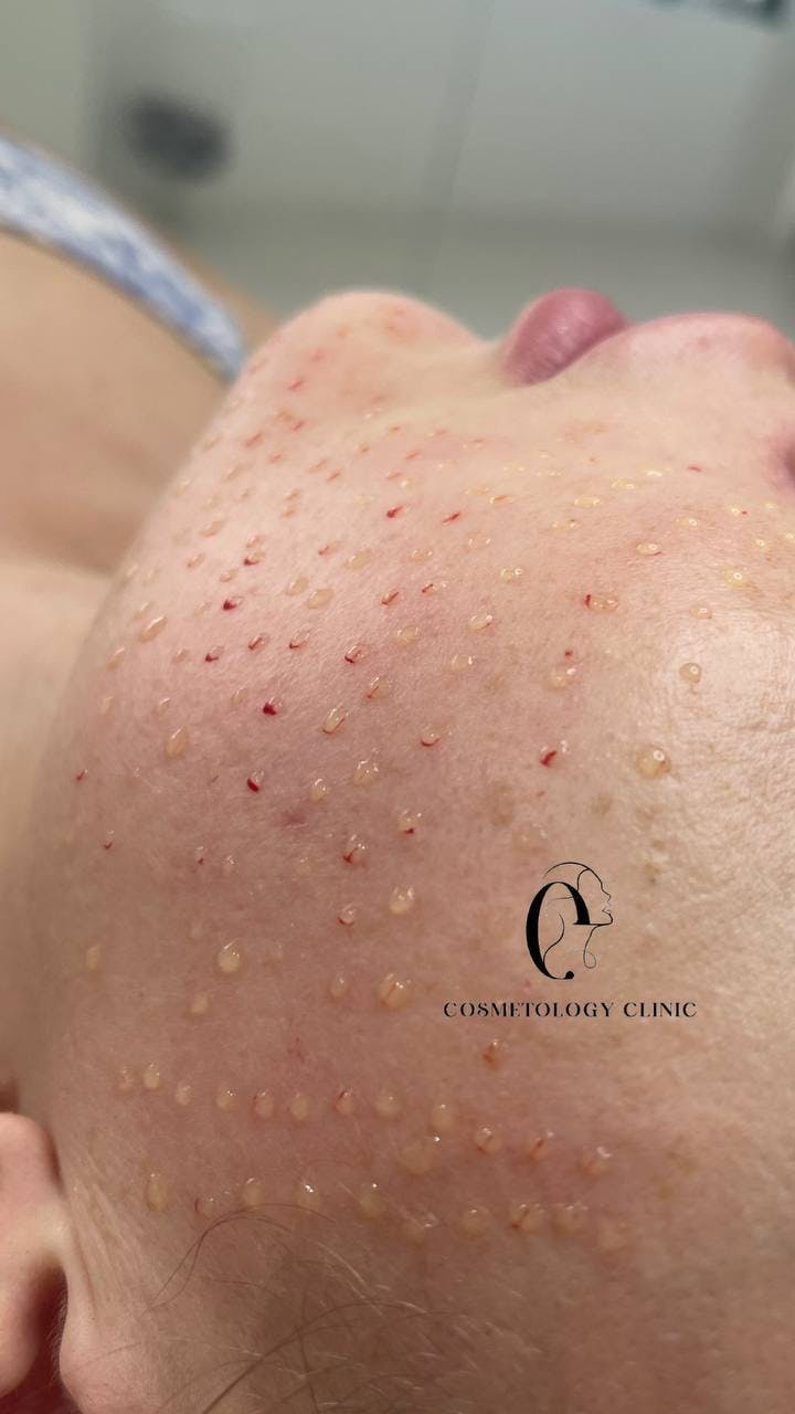 Мезотерапія обличчя