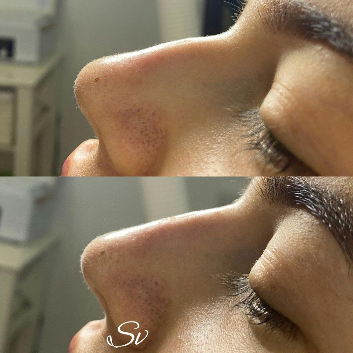 Безопераційна ринопластика