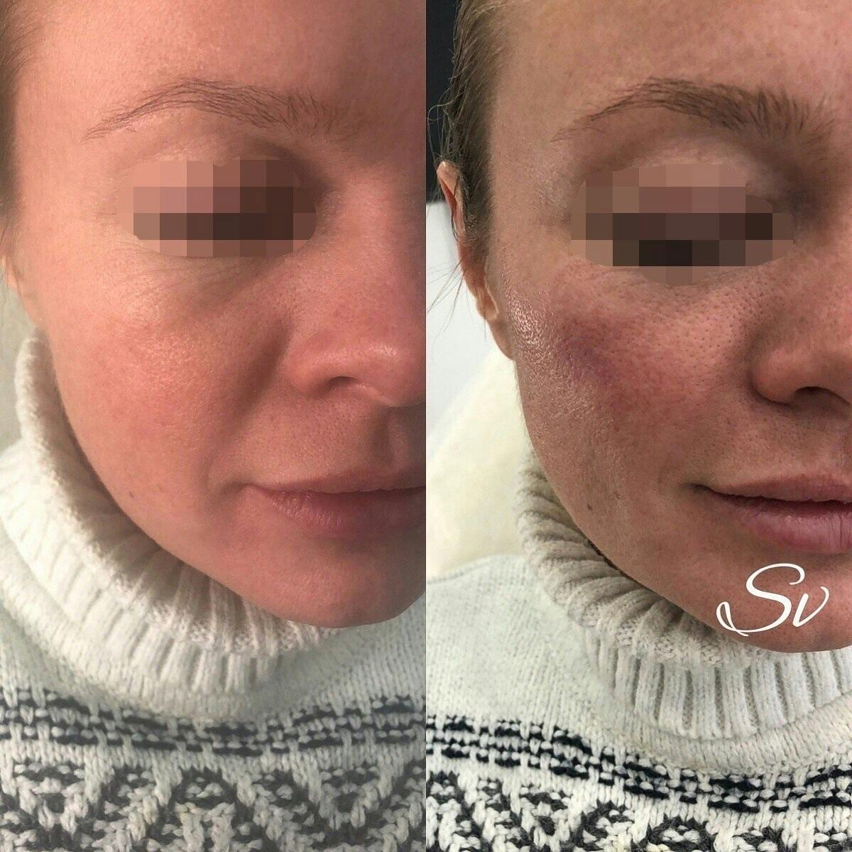 Контурна пластика скул