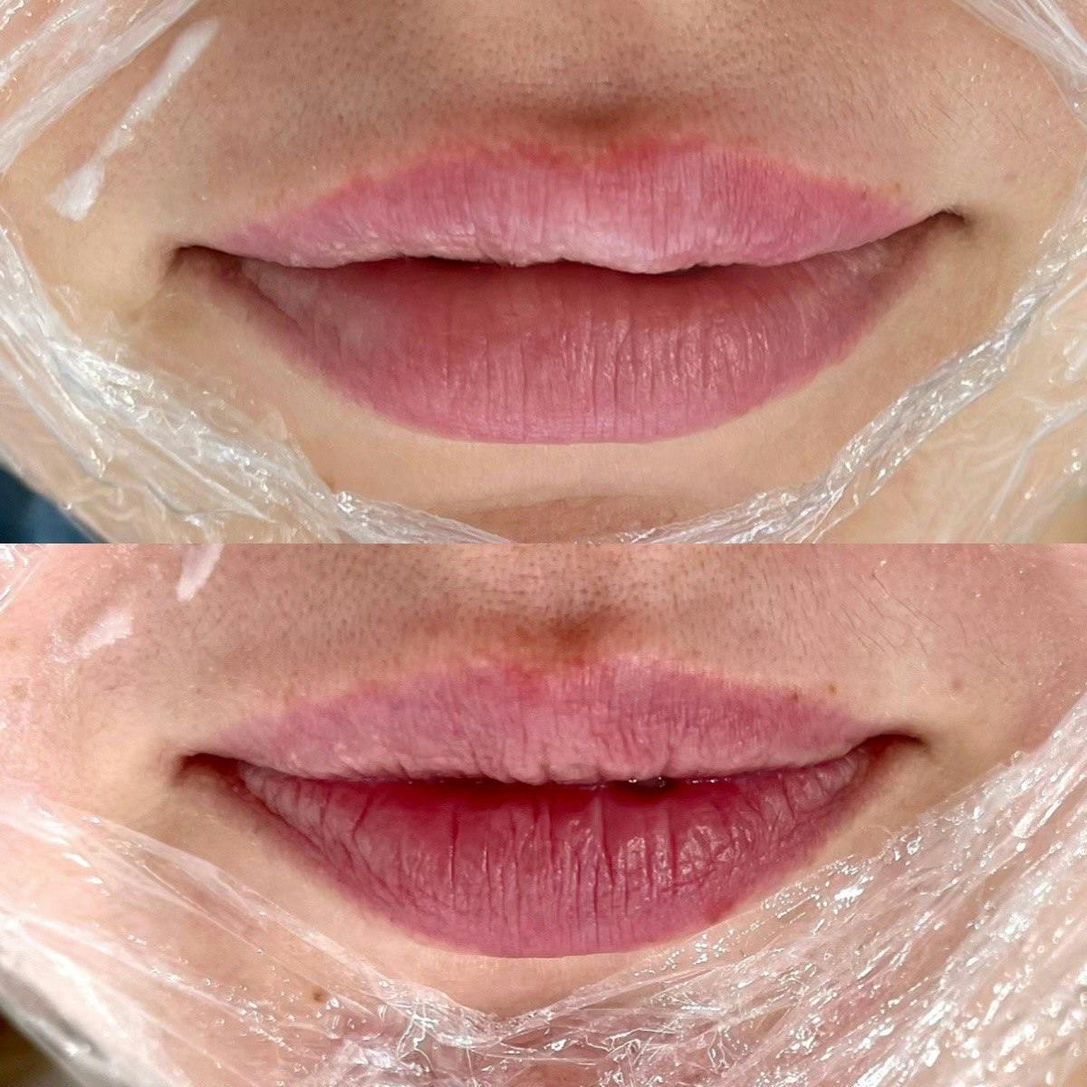 Гіалуронідаза