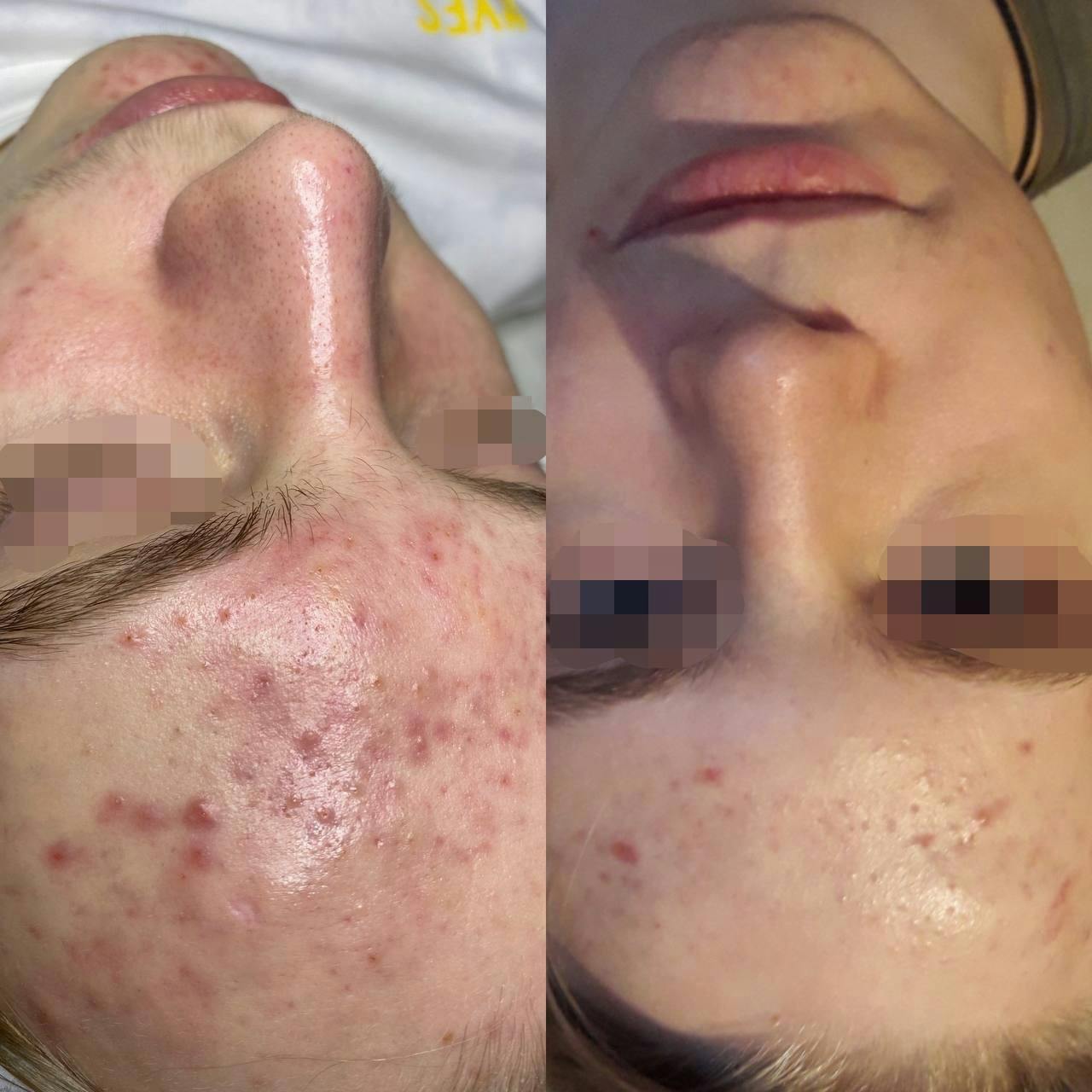 Лікування акне