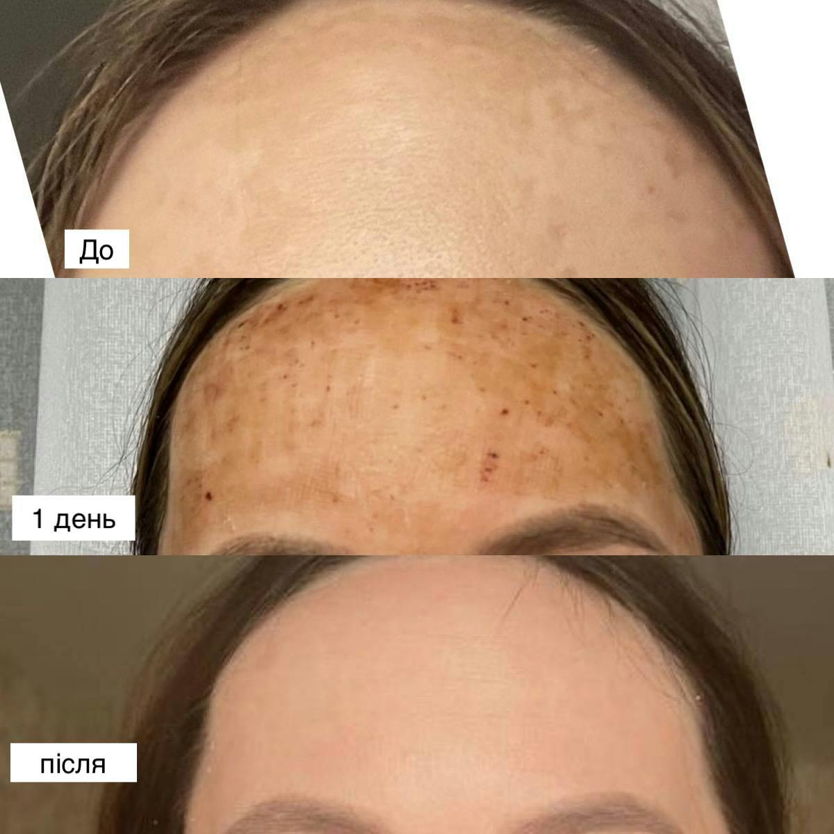 Наноперфорація