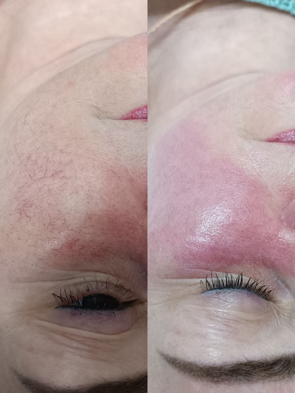 Видаленння судин