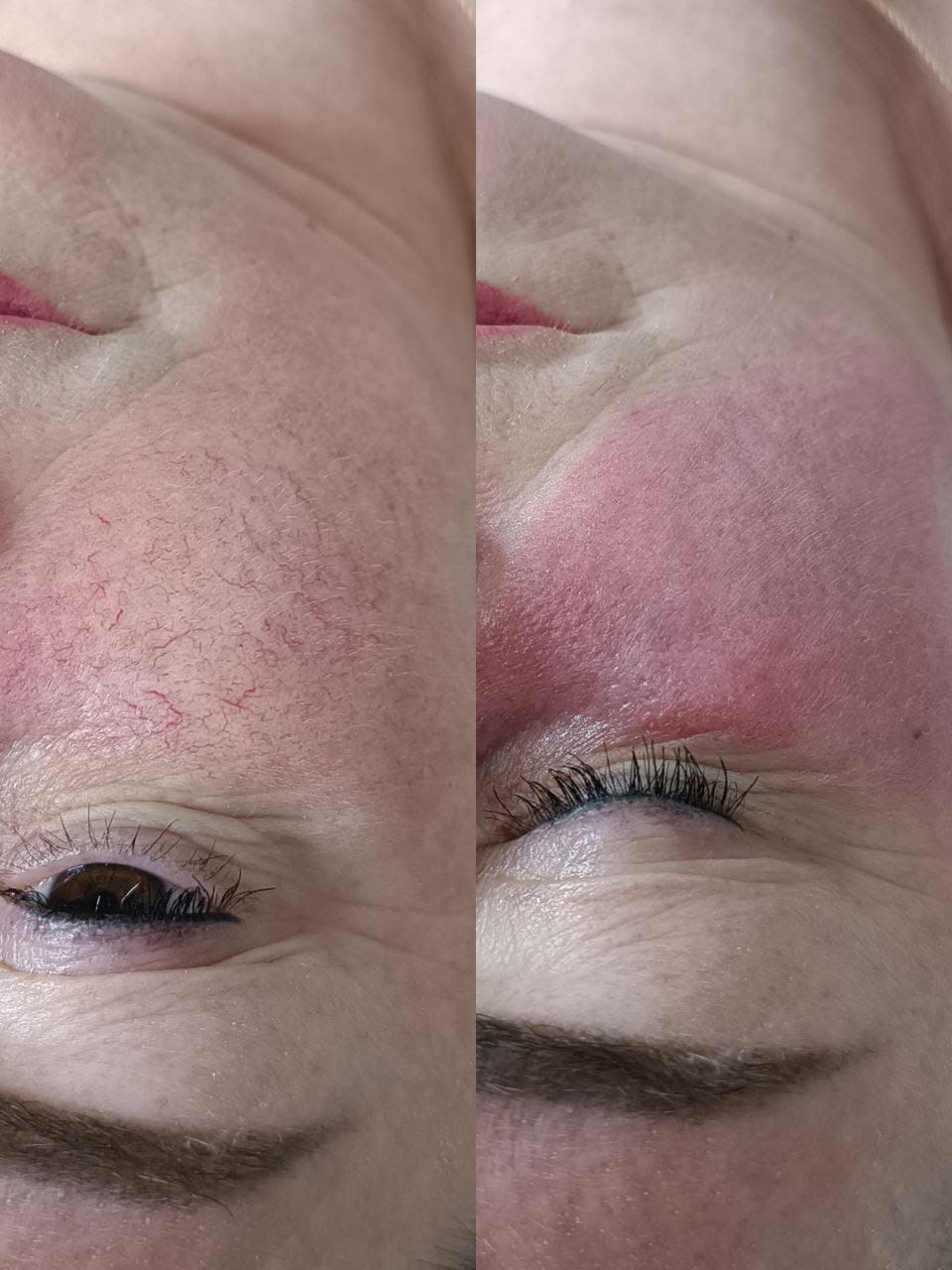 Видаленння судин