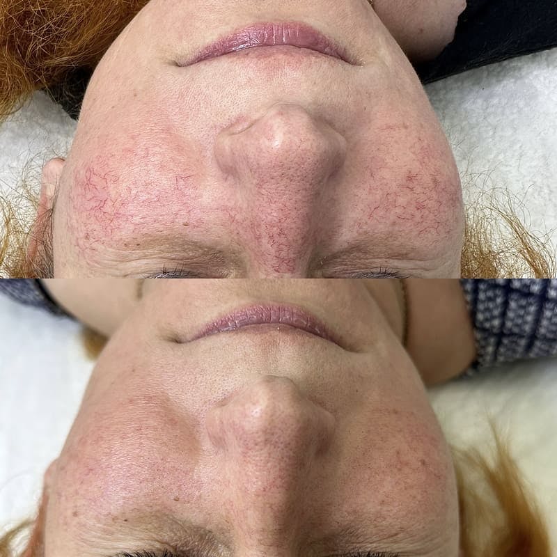 Лікування куперозу