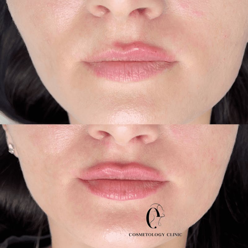 Контурна пластика губ