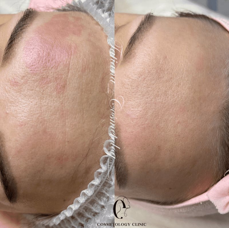 Бланшінг зморшок