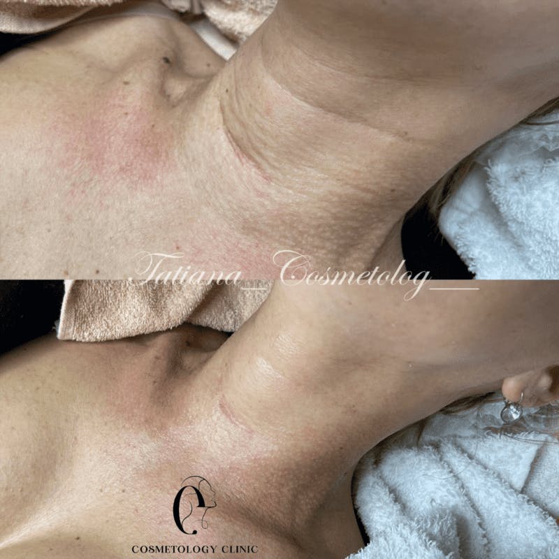 Заповнення кілець венери