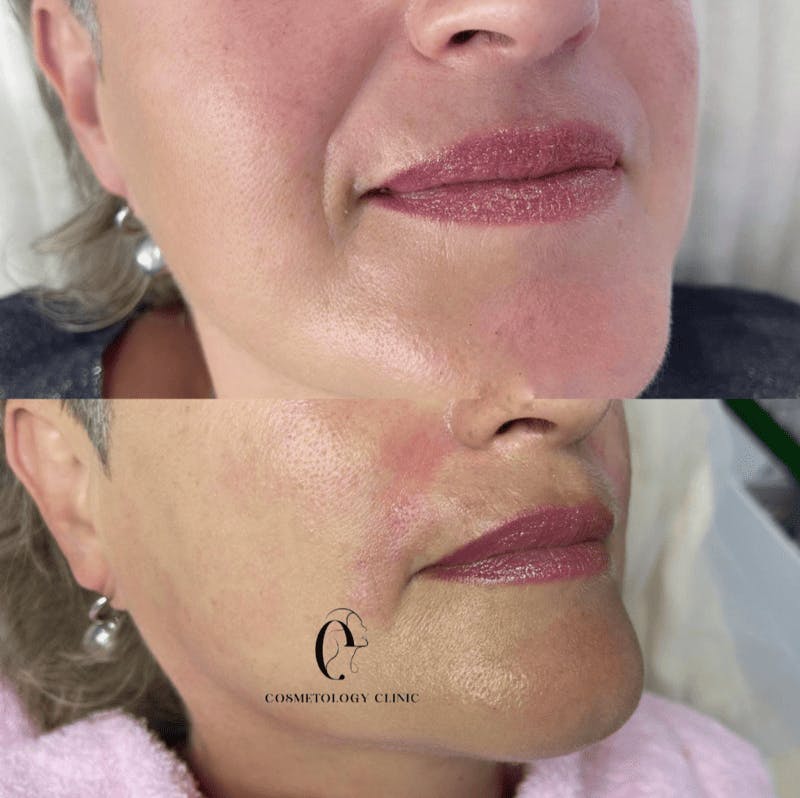 Корекція носогубних складок (заповнення)