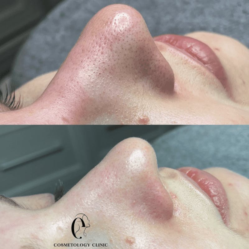 Чистка обличчя