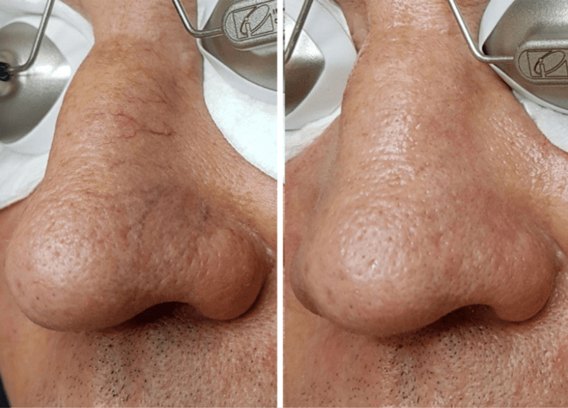 Видаленння судин