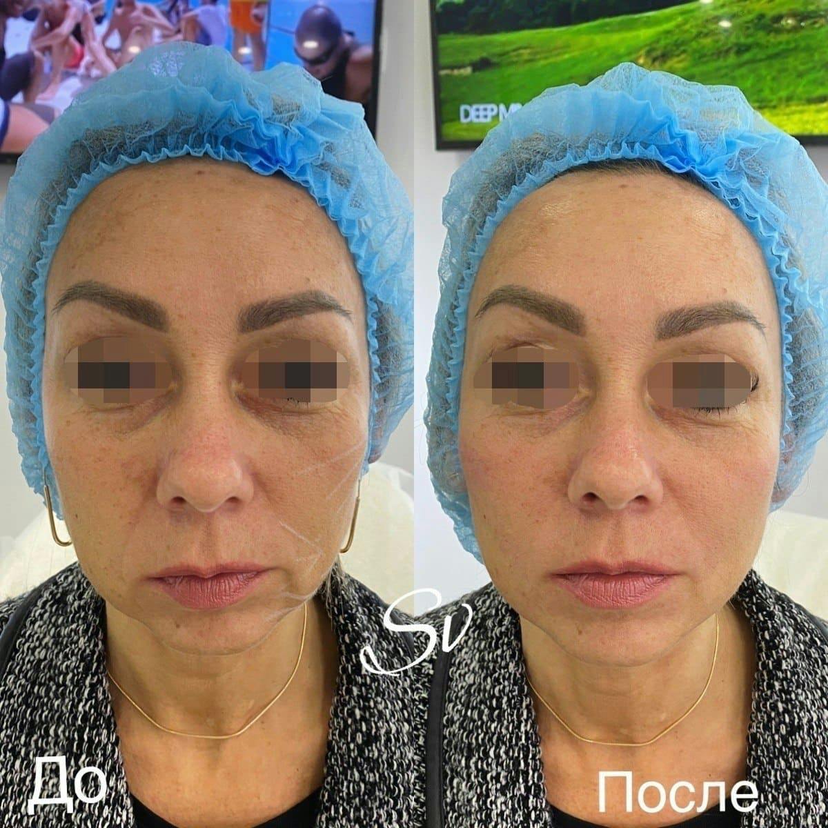 Векторний ліфтінг