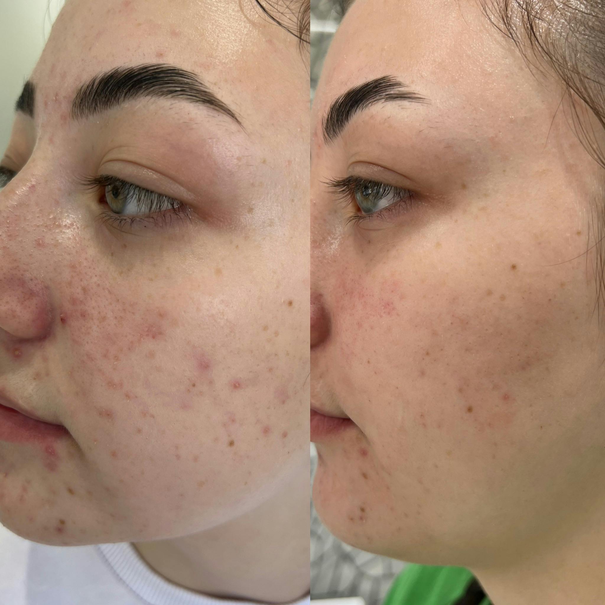 Лікування акне