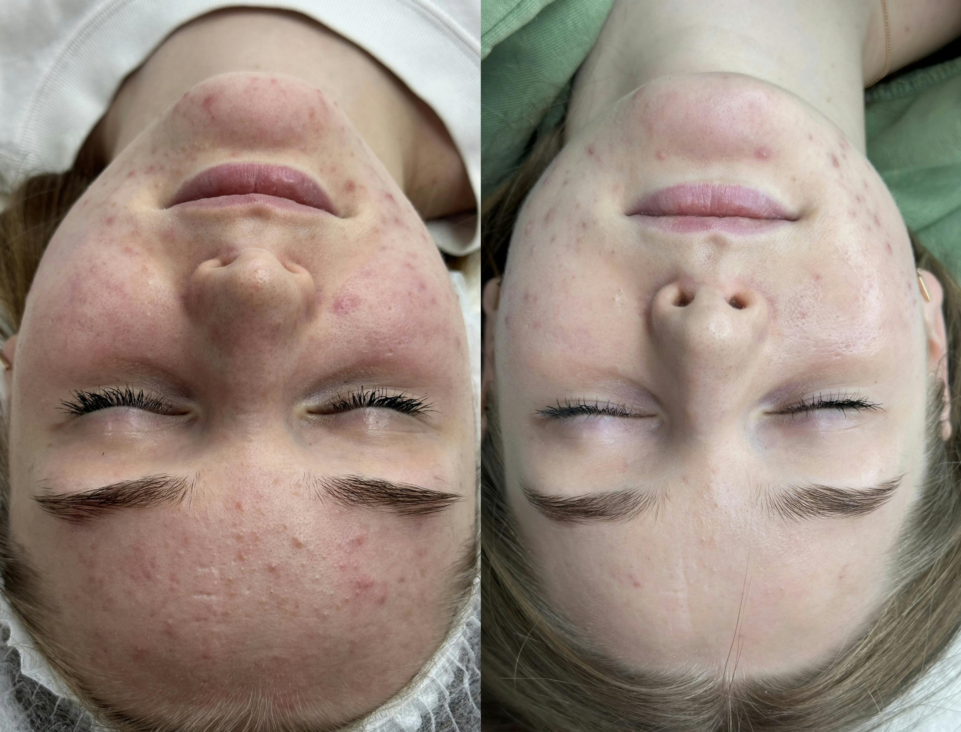 Лікування акне