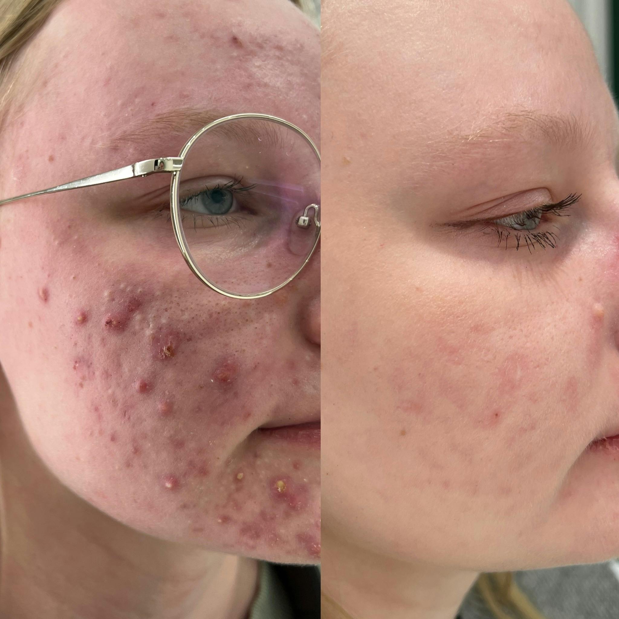 Лікування акне