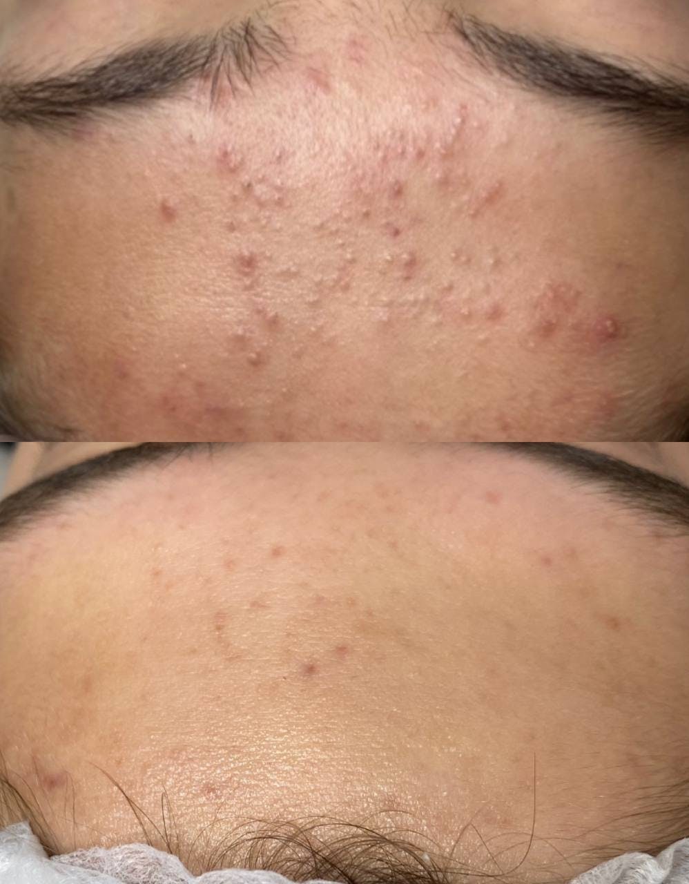 Лікування акне