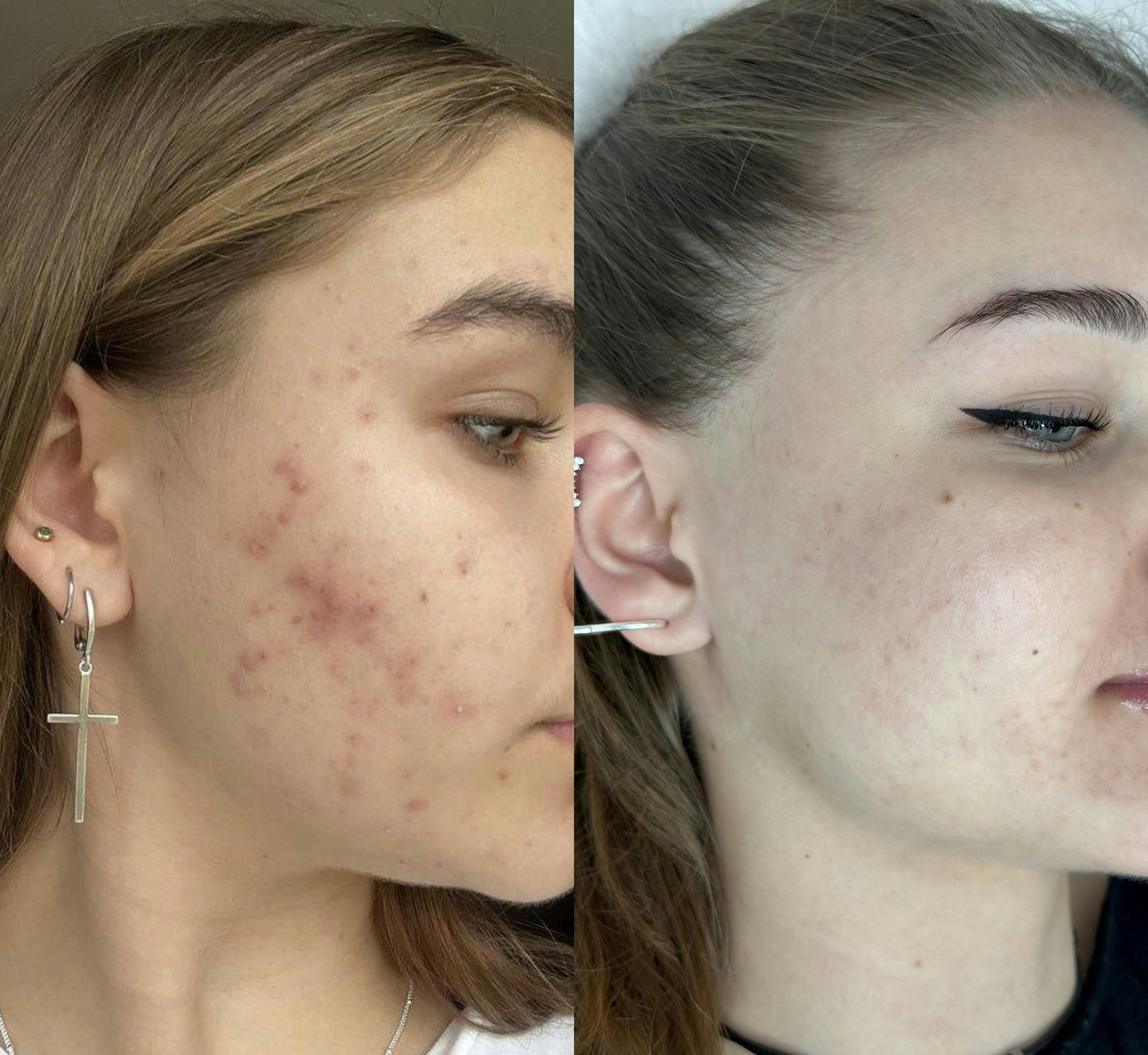 Лікування акне