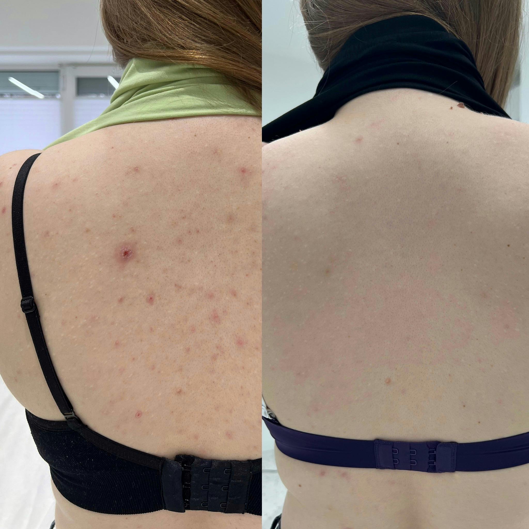 Лікування акне