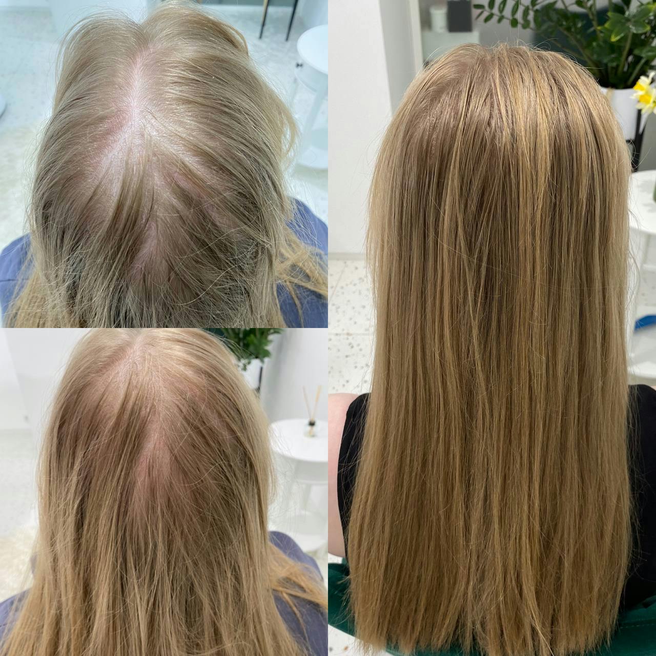 Консультація трихолога+трихоскопія