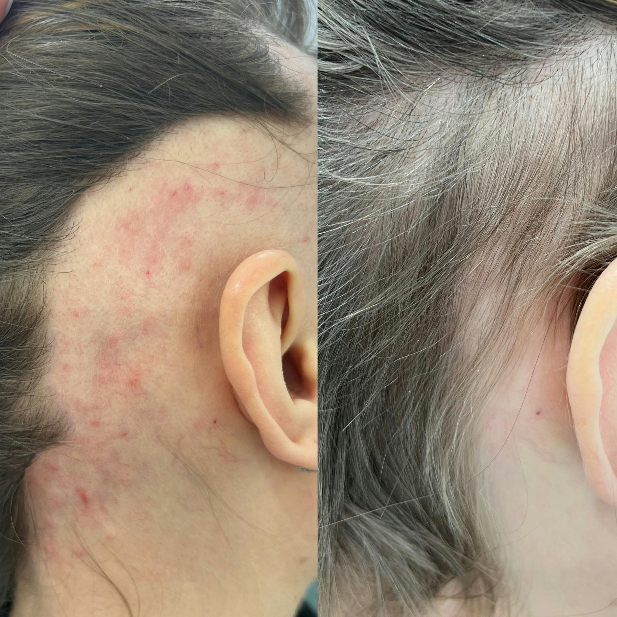 Мезотерапія волосяної частини голови