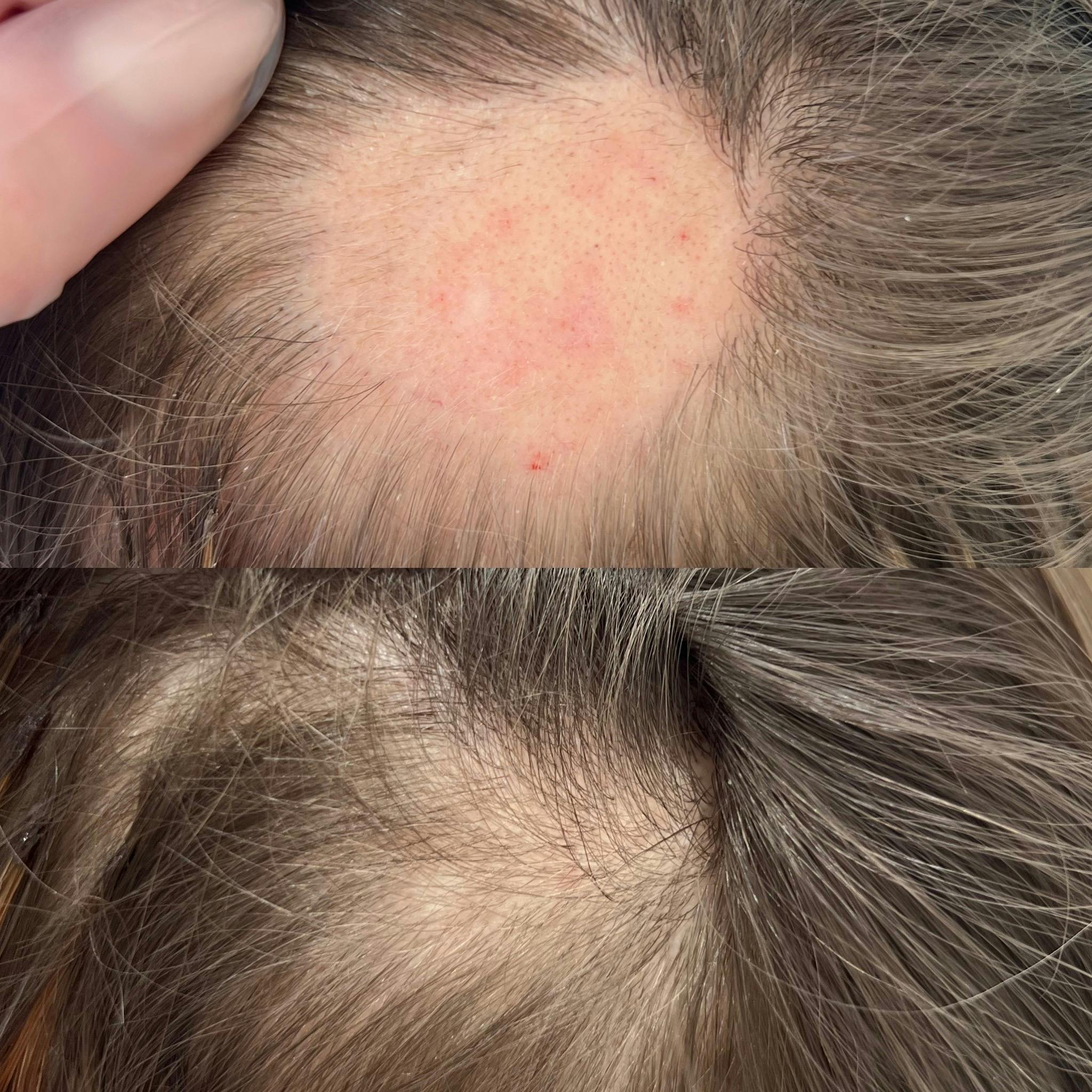 Мезотерапія волосяної частини голови