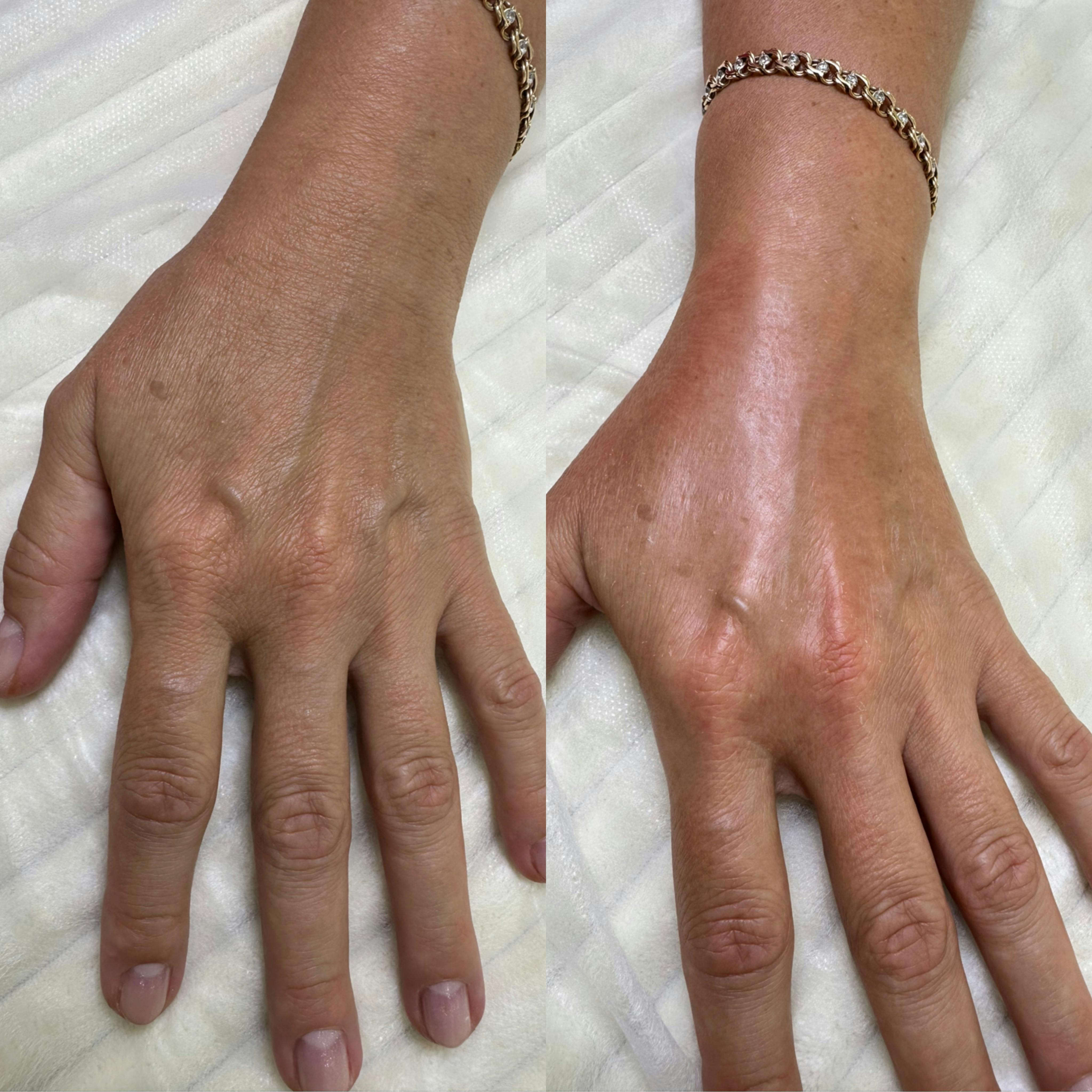 Лазерне омолодження рук