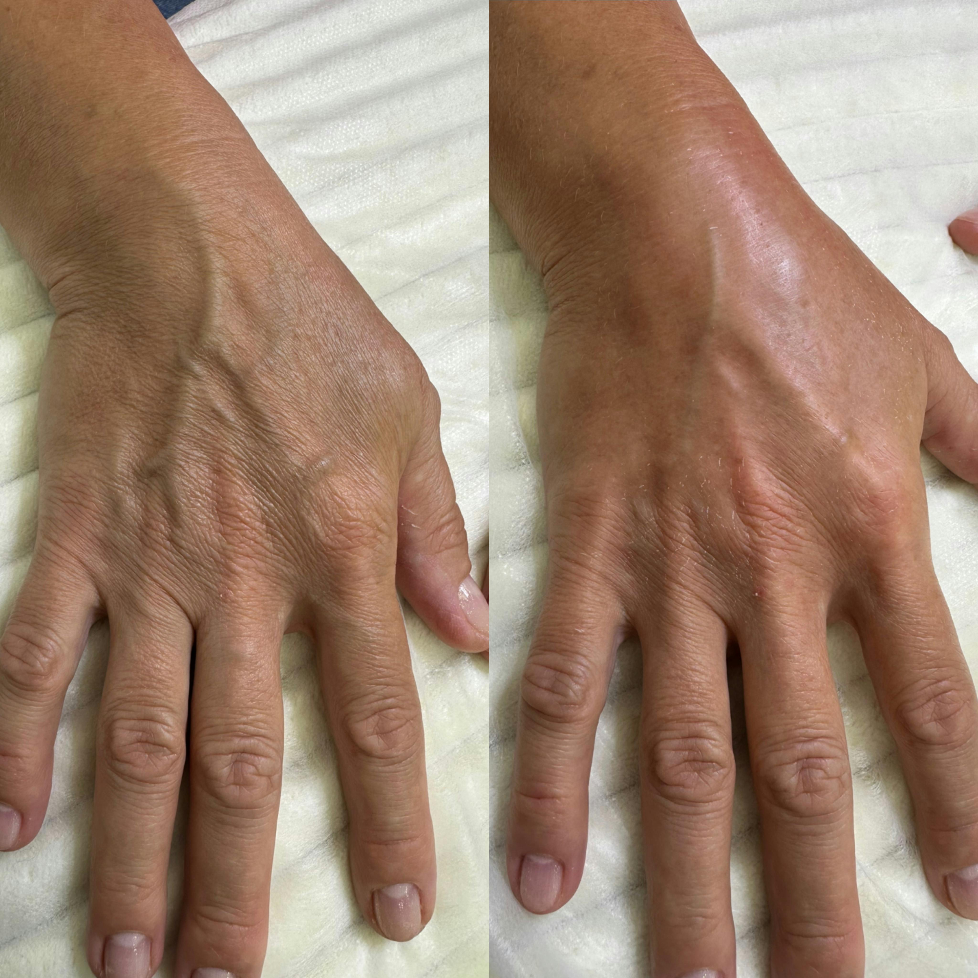 Лазерне омолодження рук