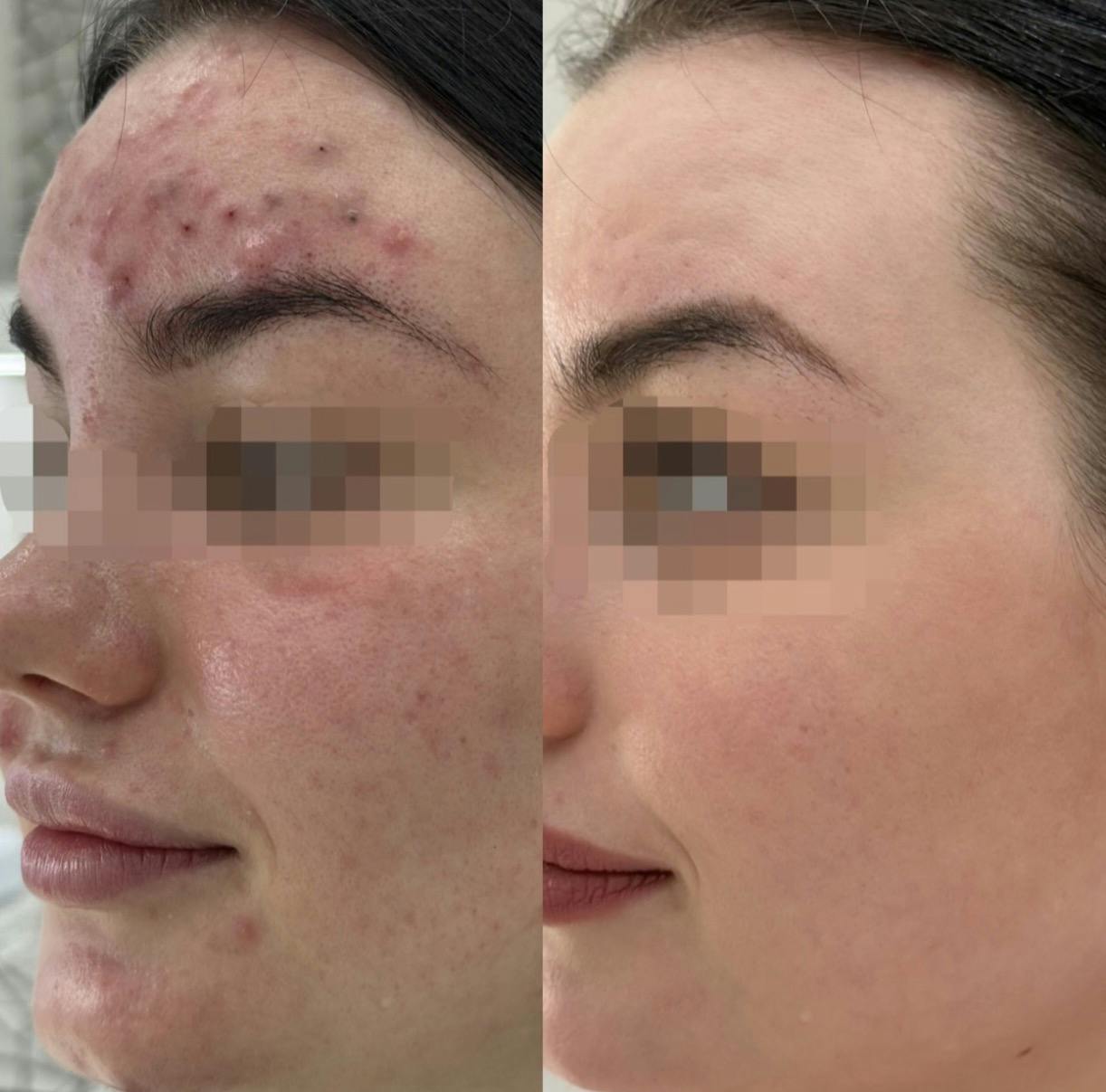 Лікування акне