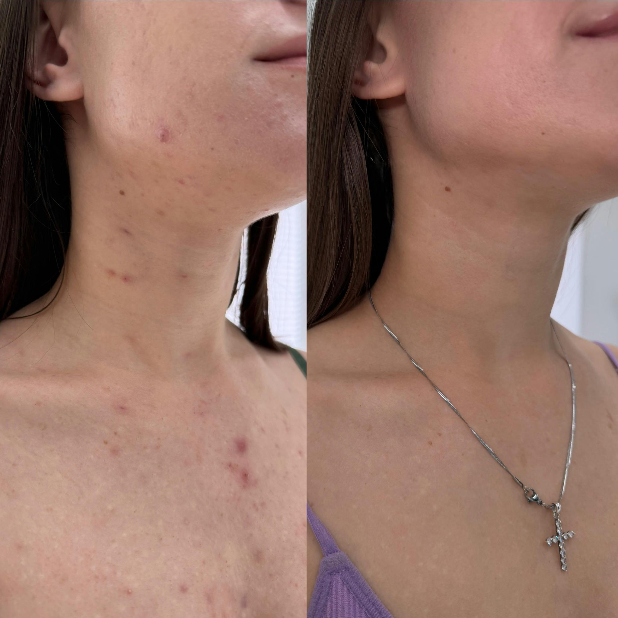 Лікування акне