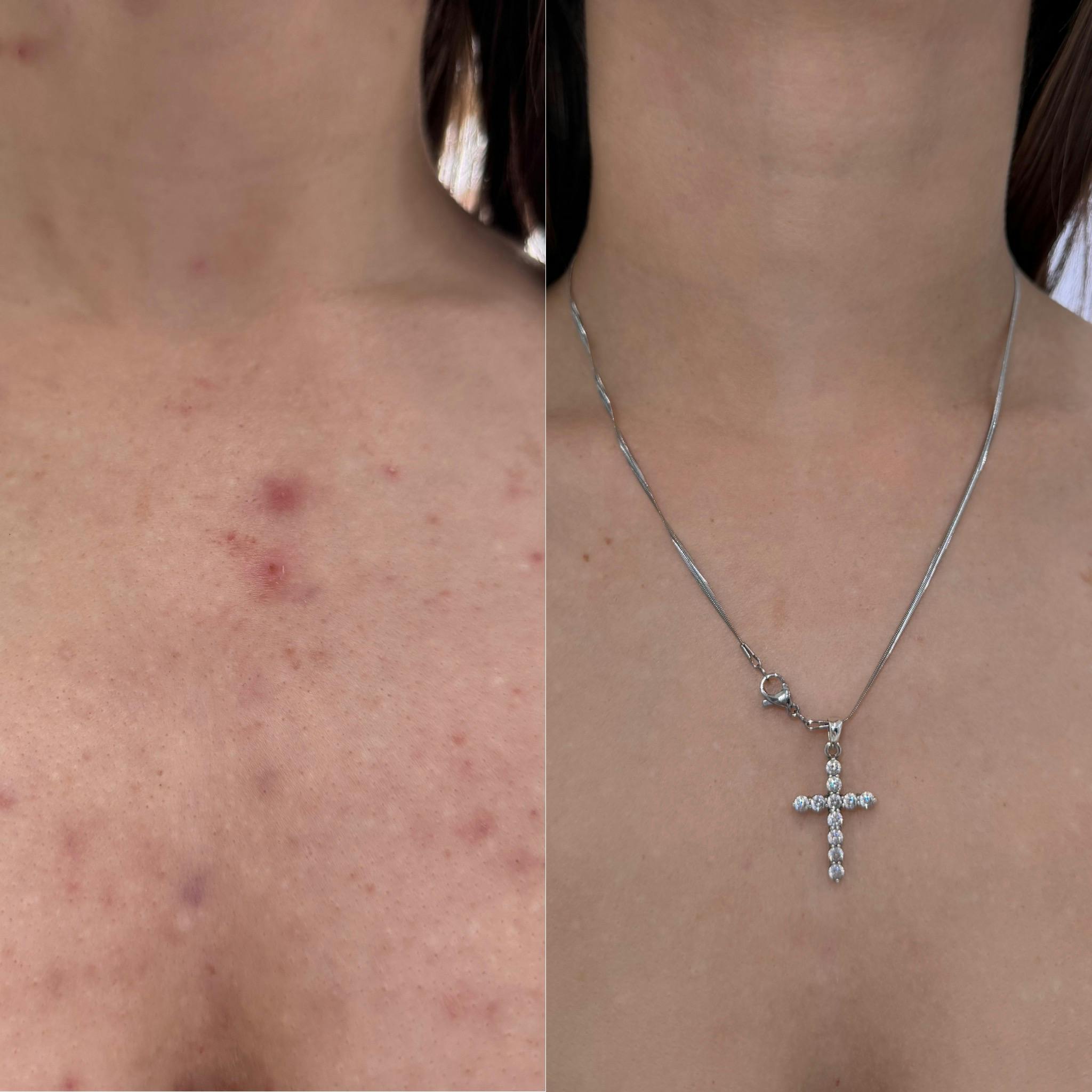 Лікування акне