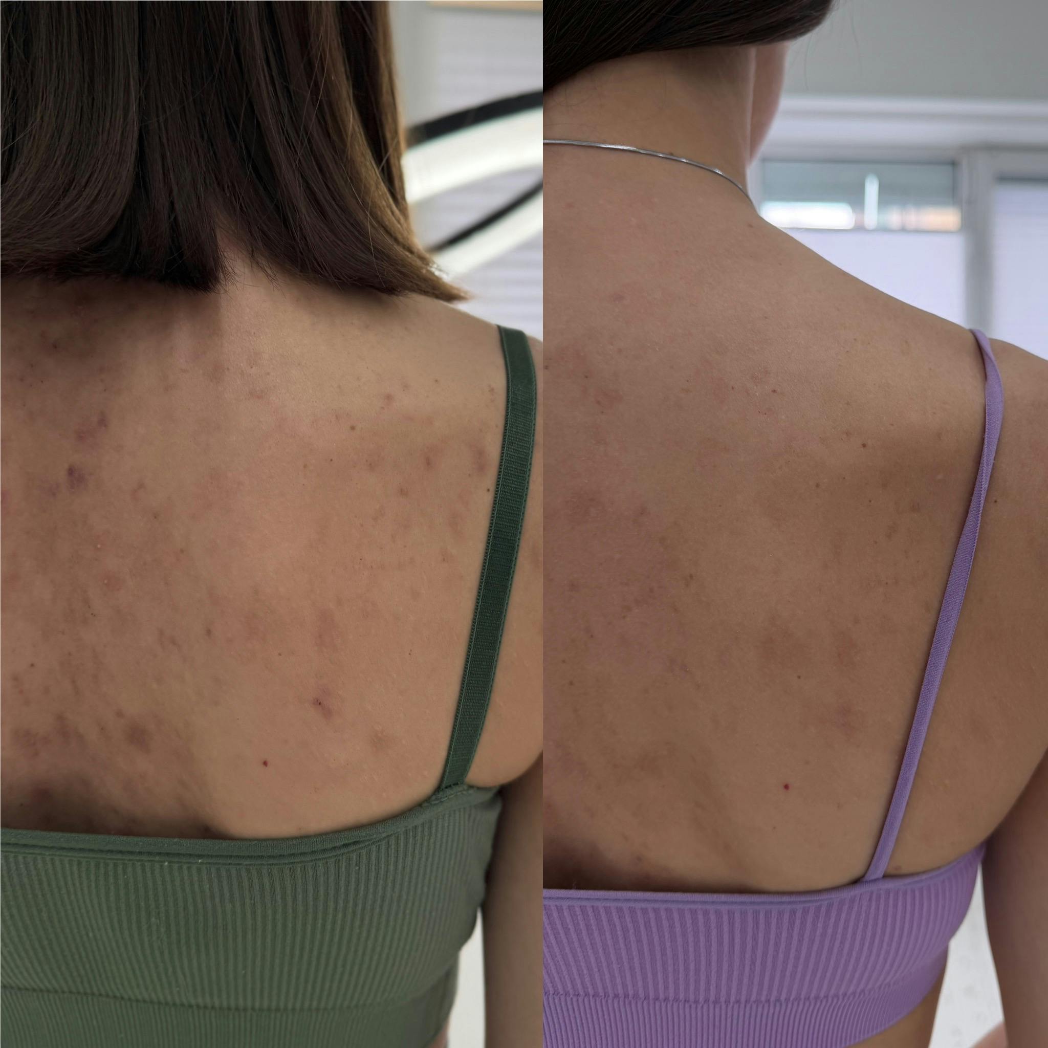 Лікування акне