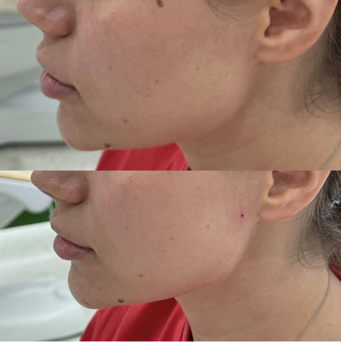 Контурна пластика (моделювання скул, підборіддя, "кутів Джолі")