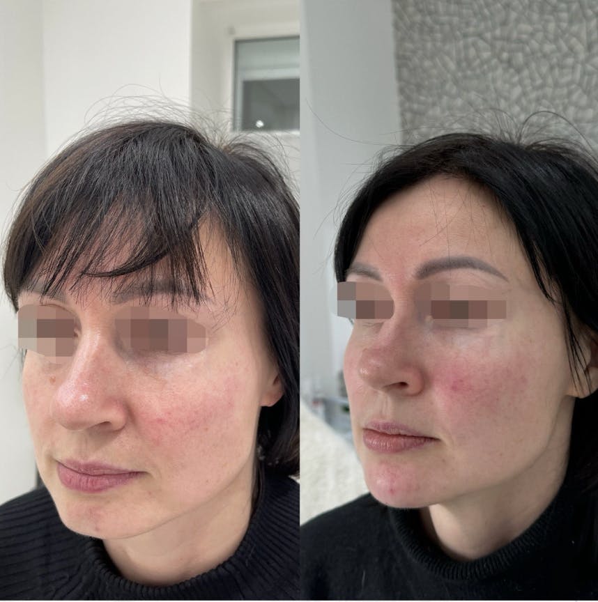 Контурна пластика (моделювання скул, підборіддя, "кутів Джолі")