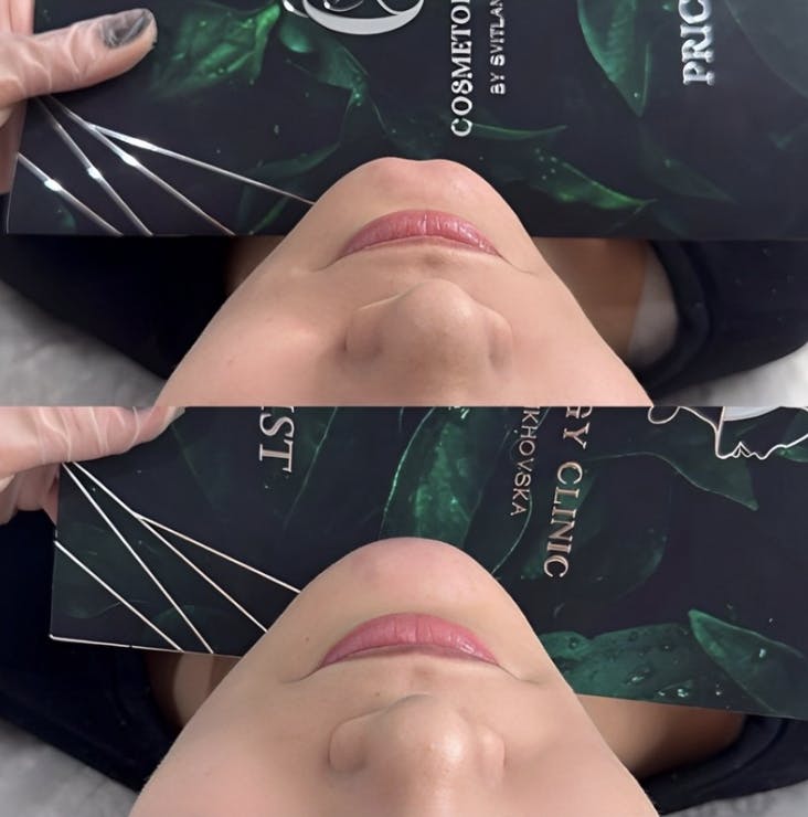 Контурна пластика (моделювання скул, підборіддя, "кутів Джолі")