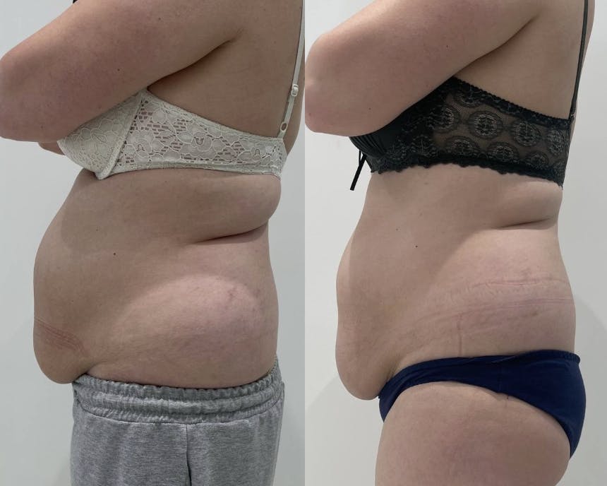 Ліполітична терапія