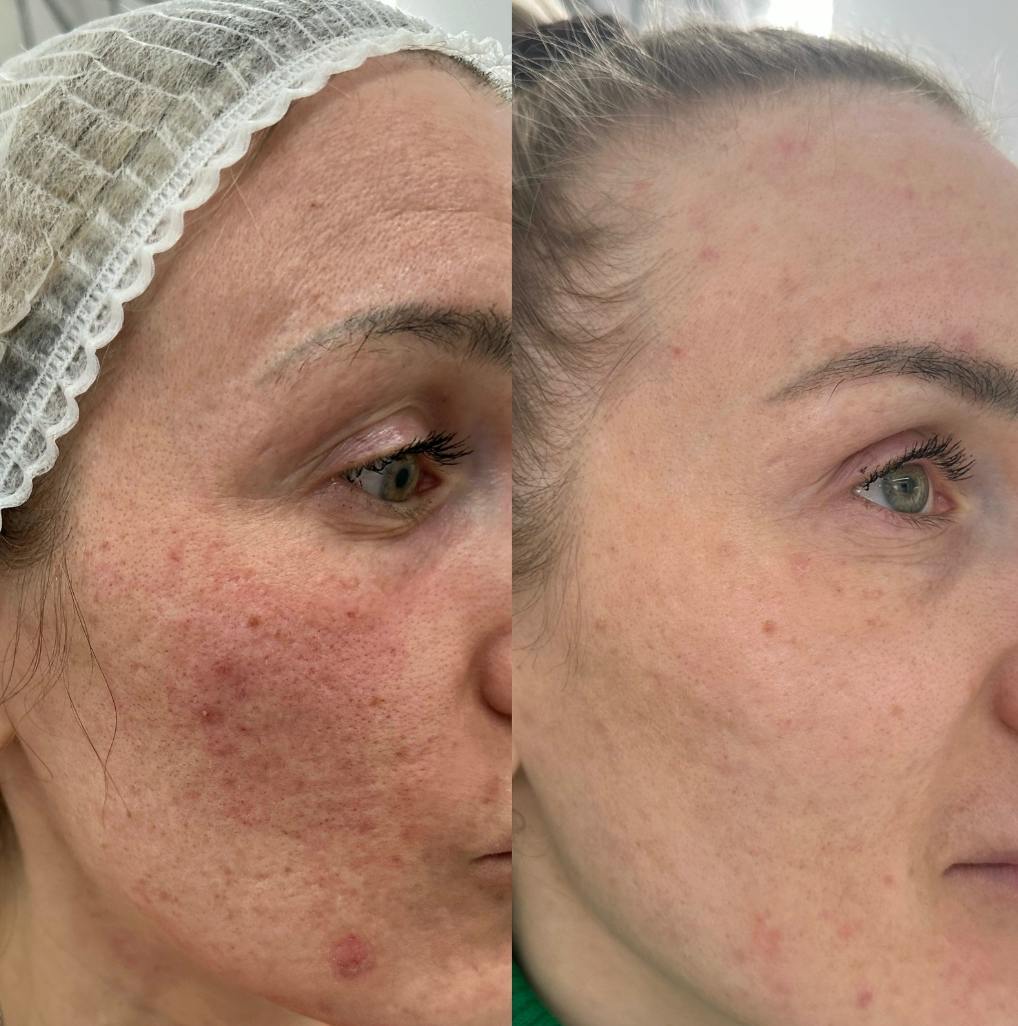 Лазерний пілінг (глибоке шліфування обличчя)