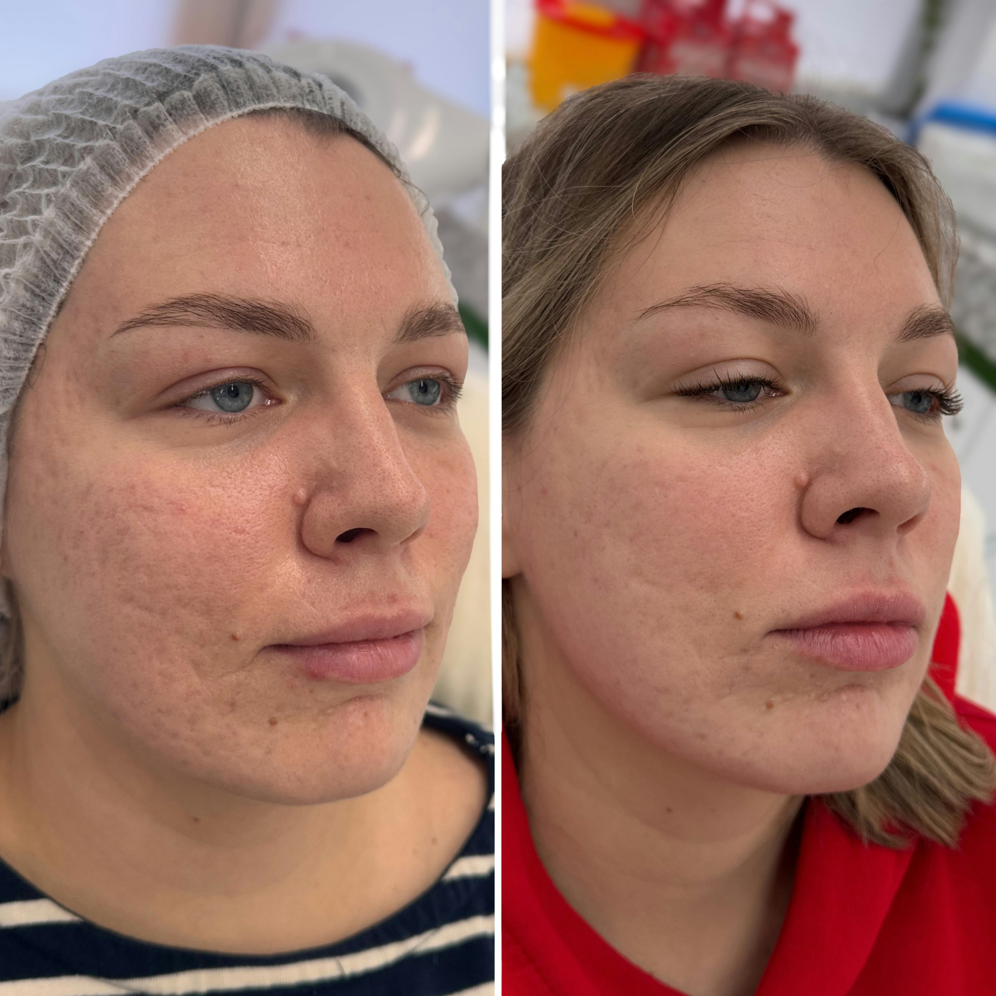 Лазерний пілінг (глибоке шліфування обличчя)