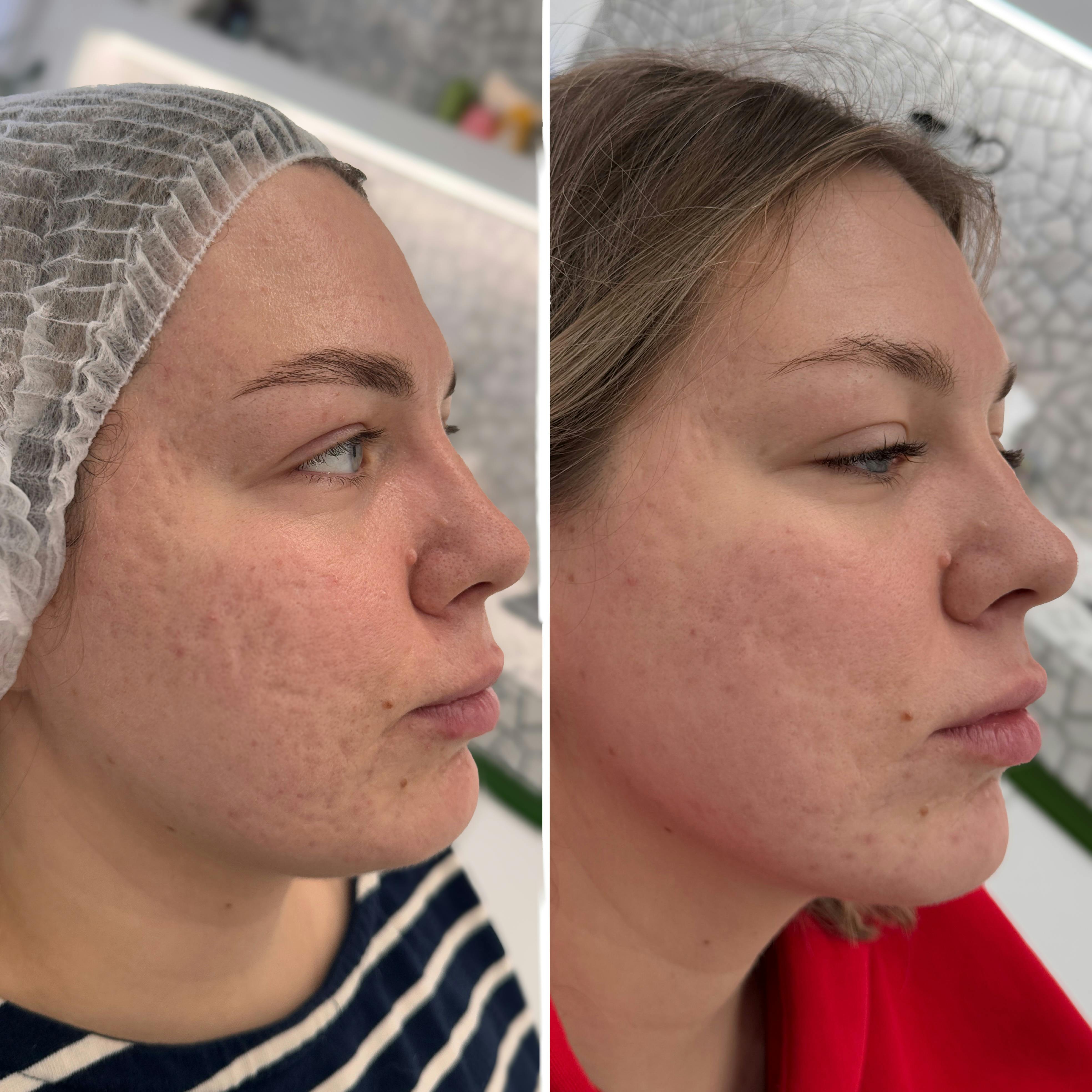 Лазерний пілінг (глибоке шліфування обличчя)