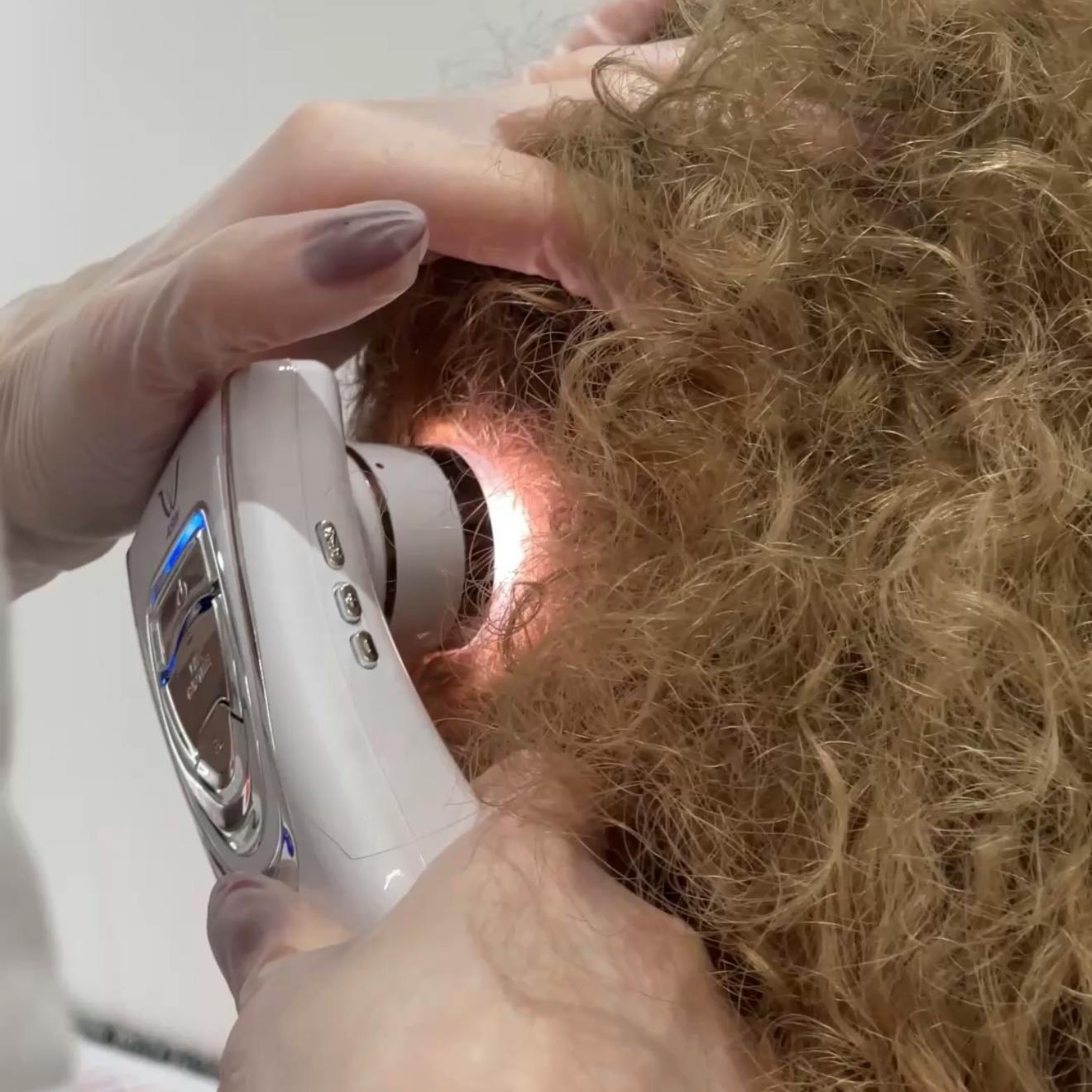 Консультація трихолога + трихоскопія