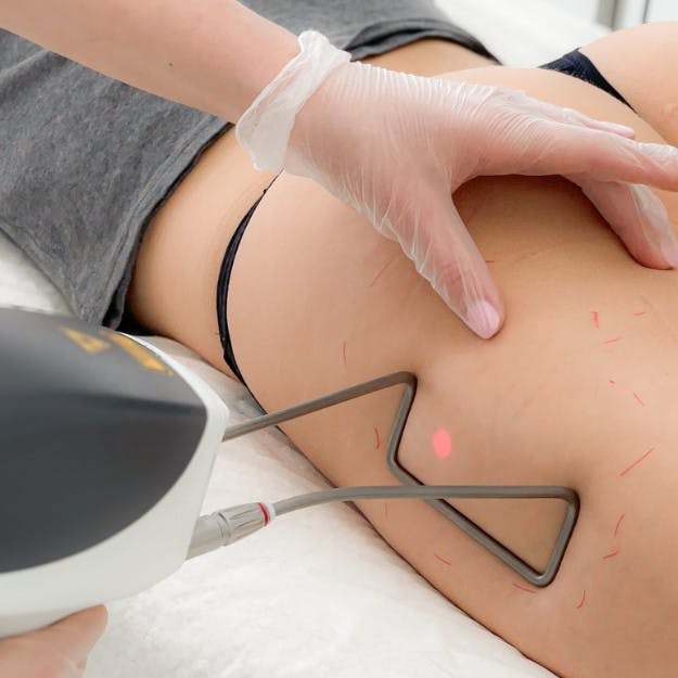 TightSculpting (ліполітична програма)