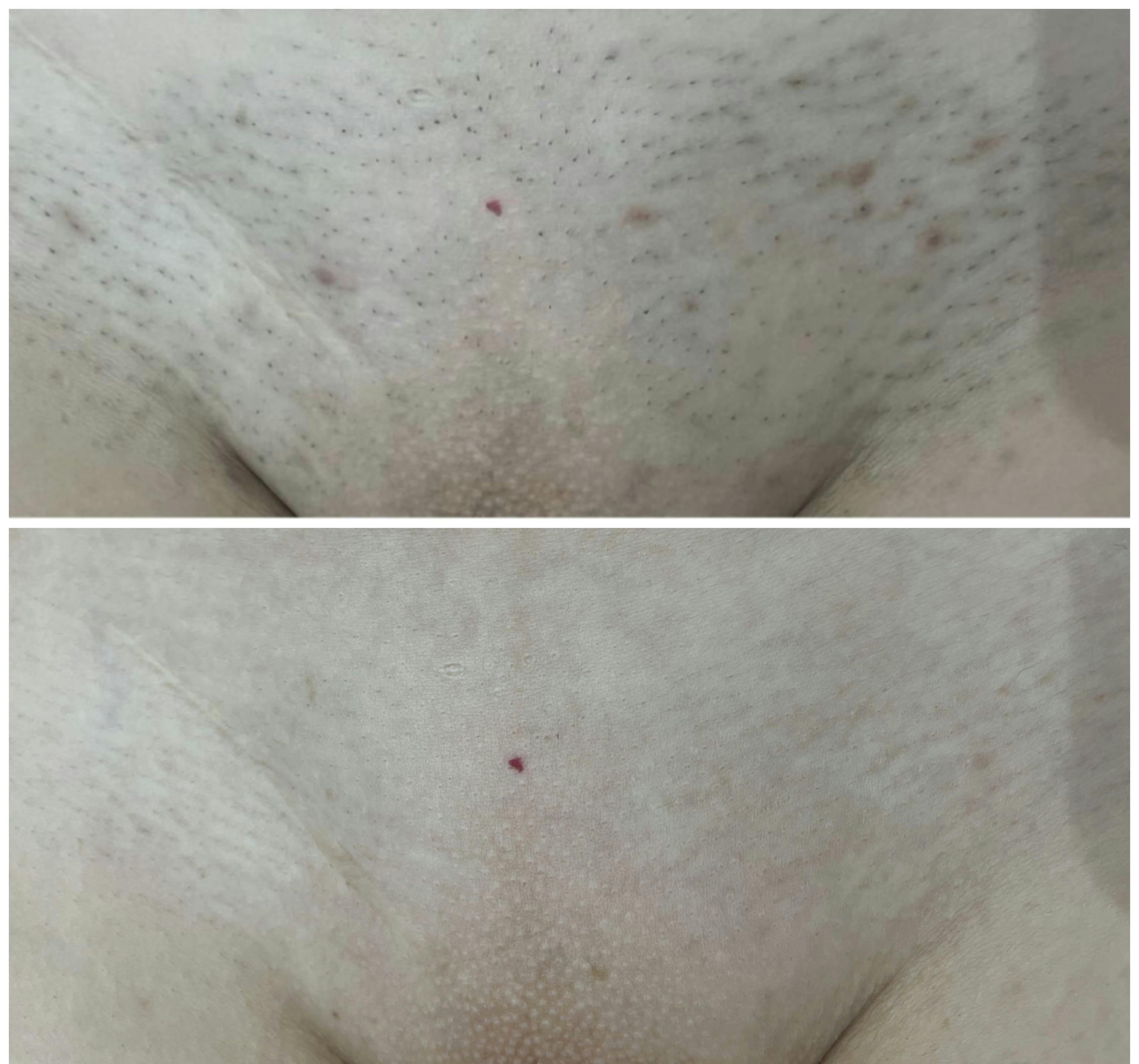 Лазерна епіляція Candela Gentle Max Pro